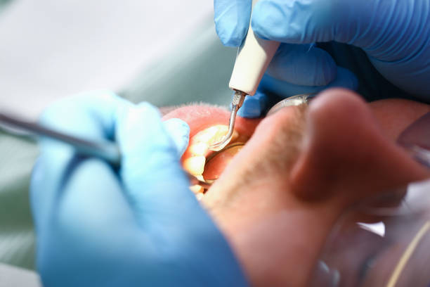 Best Emergency Dentist for Lost Fillings or Crowns in Silverdale, WA